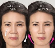 Lift Treatment - Younger Looking | Firm | HIFU | Thread Lift | Non-Surgical Facelift