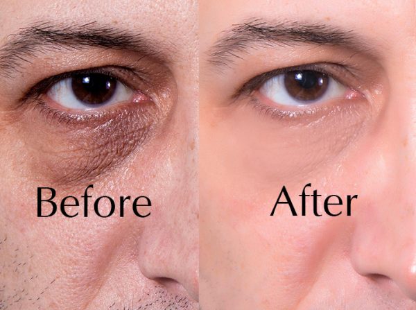 Dr.D Clinic Dark eye circles Treatment