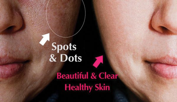 Spots & Dots Treatment - Pigmentation Free | Clear Skin | Flawless Skin | Bright & Luminous Skin