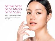 Dr.D Clinic Acne Treatment - Acne Free | Clear Skin | Smooth Skin | Scar Free