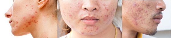 Dr.D Clinic Acne Treatment - Acne Free | Clear Skin | Smooth Skin | Scar Free