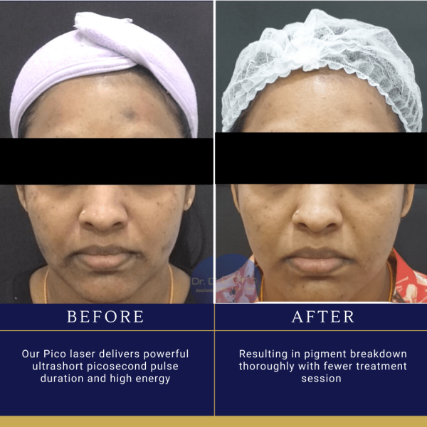 Pico Laser Treatment